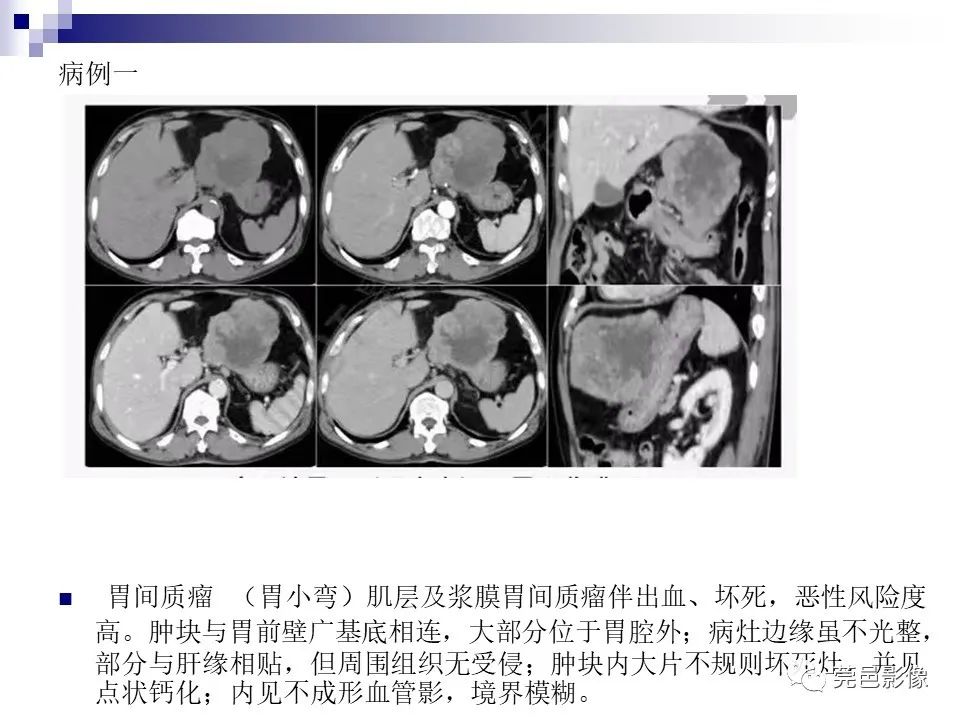 影像PPT - 【PPT】一例少见巨块外生型肝癌CT诊断及文献学习-24