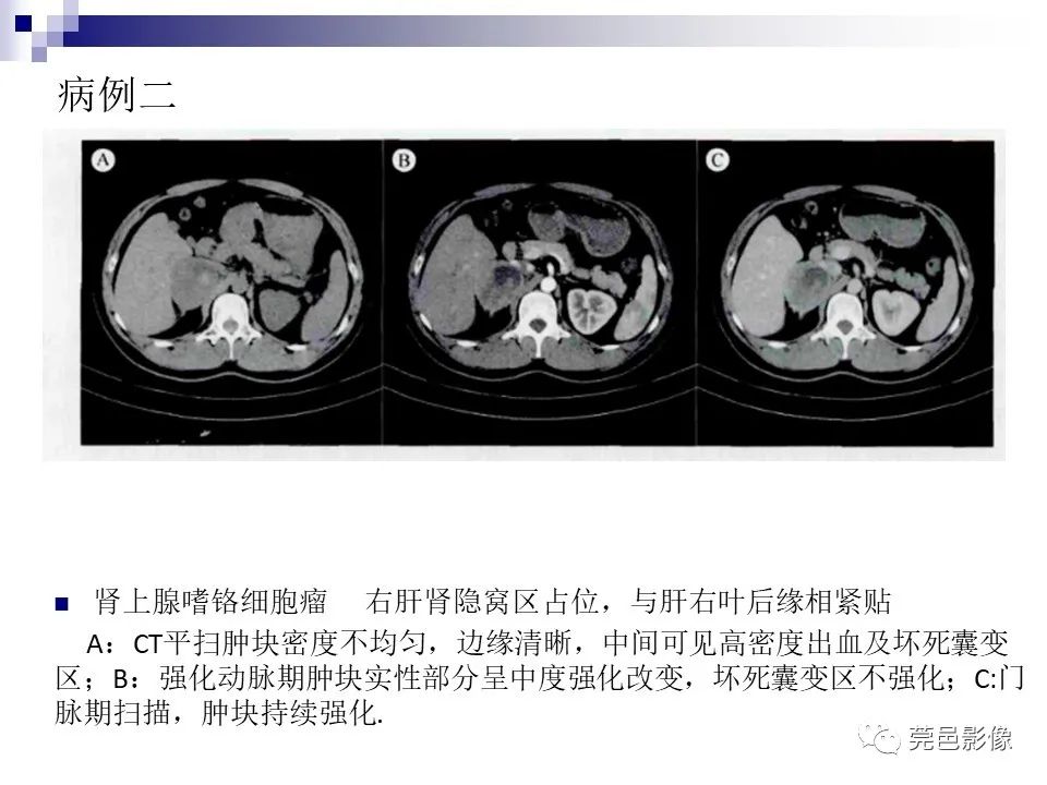 影像PPT - 【PPT】一例少见巨块外生型肝癌CT诊断及文献学习-25