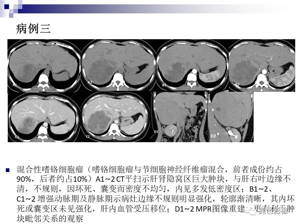 影像PPT - 【PPT】一例少见巨块外生型肝癌CT诊断及文献学习-26