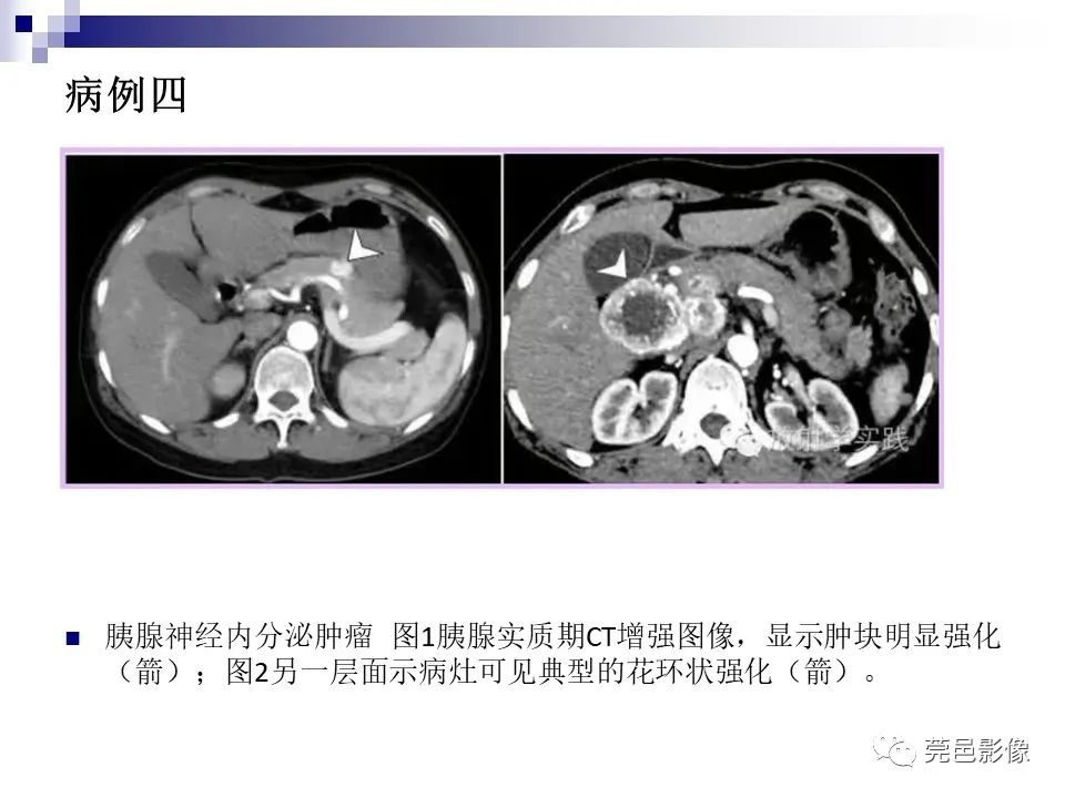 影像PPT - 【PPT】一例少见巨块外生型肝癌CT诊断及文献学习-27