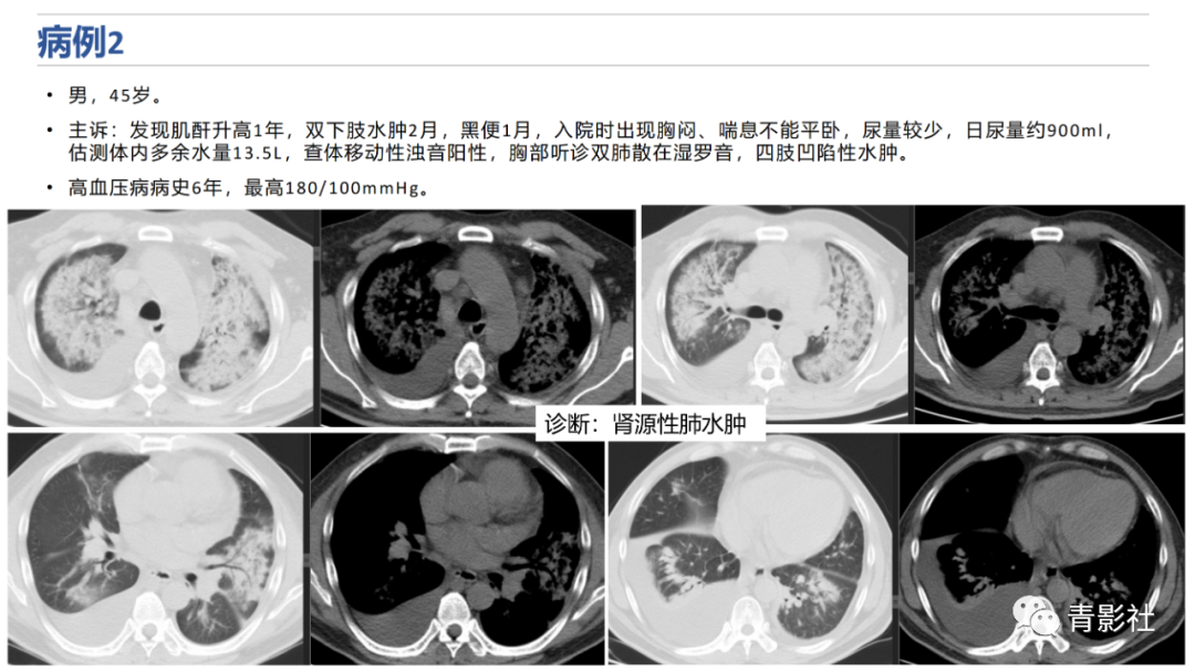 影像PPT - 【PPT】肺水肿的影像诊断-15