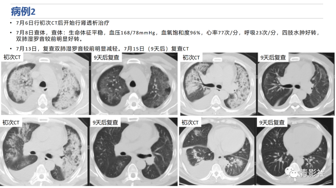 影像PPT - 【PPT】肺水肿的影像诊断-16