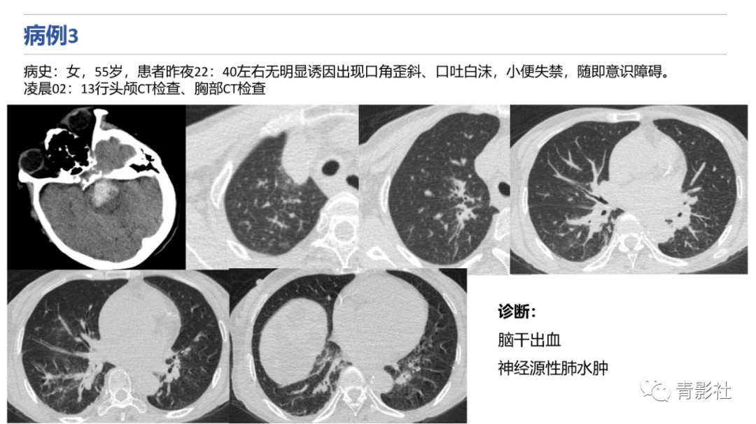 影像PPT - 【PPT】肺水肿的影像诊断-18