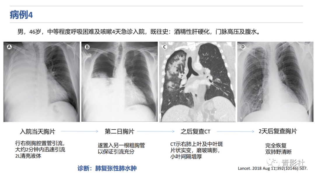 影像PPT - 【PPT】肺水肿的影像诊断-21