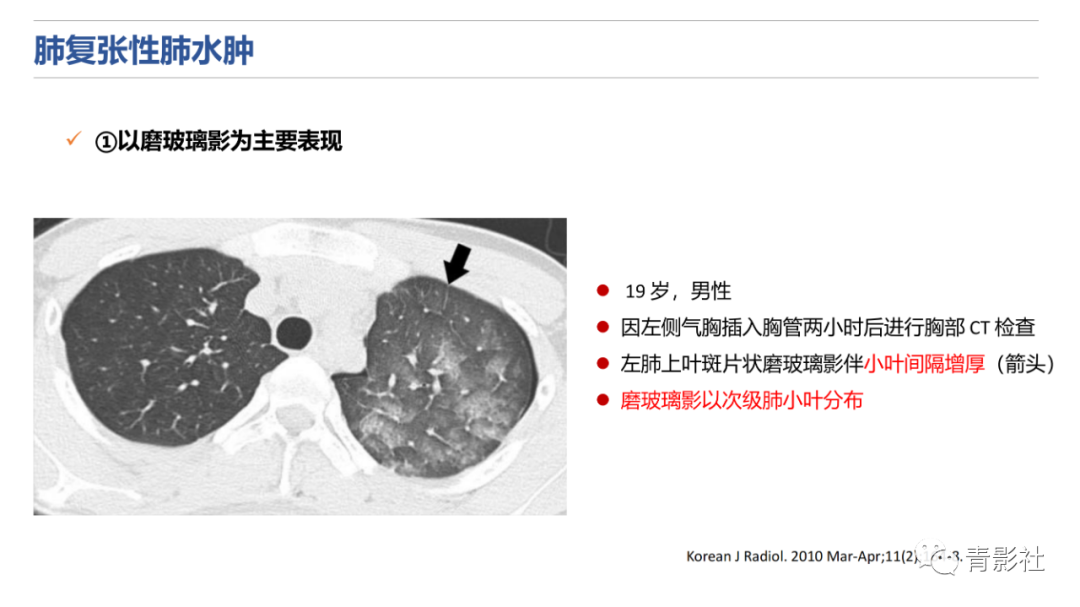 影像PPT - 【PPT】肺水肿的影像诊断-23
