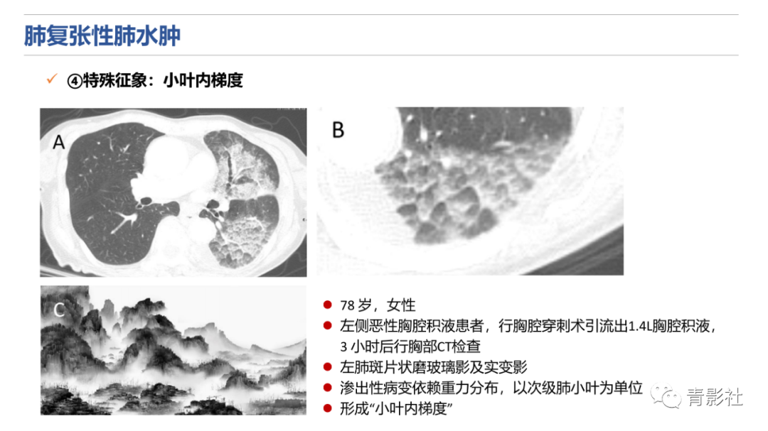 影像PPT - 【PPT】肺水肿的影像诊断-26