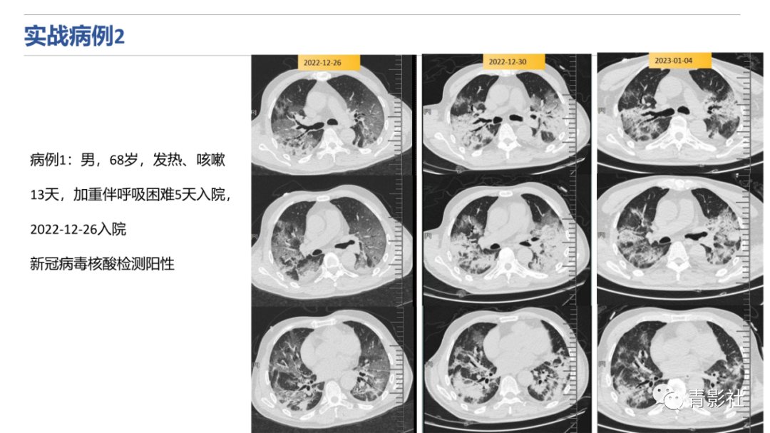 影像PPT - 【PPT】肺水肿的影像诊断-31