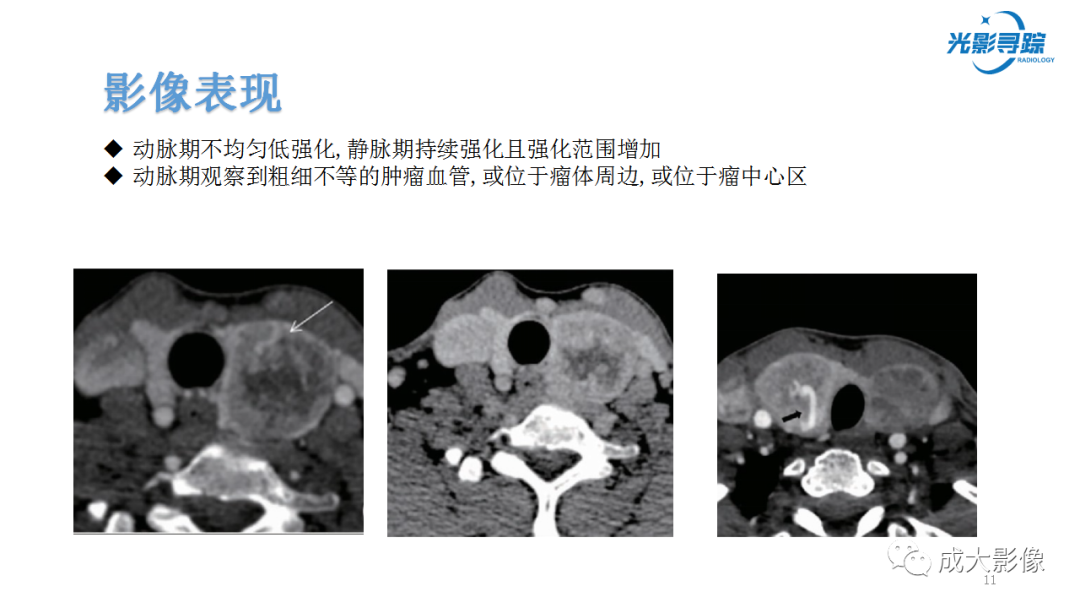 影像PPT - 【PPT】甲状腺髓样癌影像表现-6