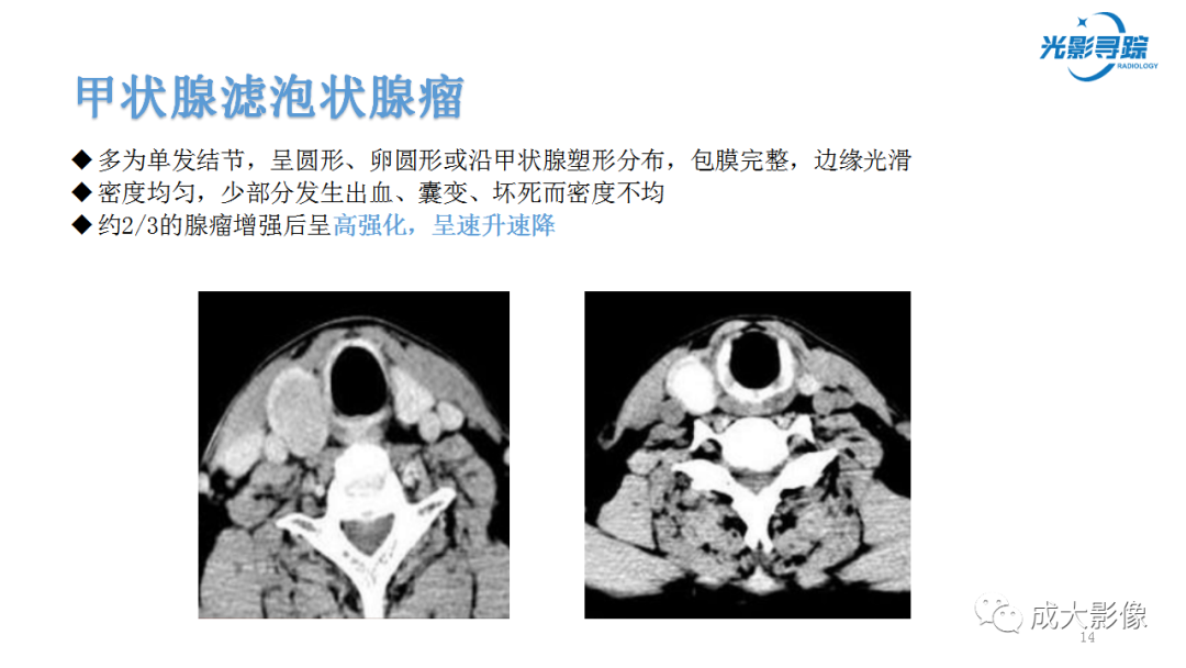 影像PPT - 【PPT】甲状腺髓样癌影像表现-9