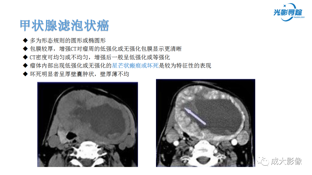 影像PPT - 【PPT】甲状腺髓样癌影像表现-13