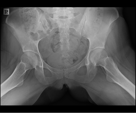 影像PPT - 【病例】骶骨功能不全骨折1例X线MR-3 影像PPT - 【病例】骶骨功能不全骨折1例X线MR-3