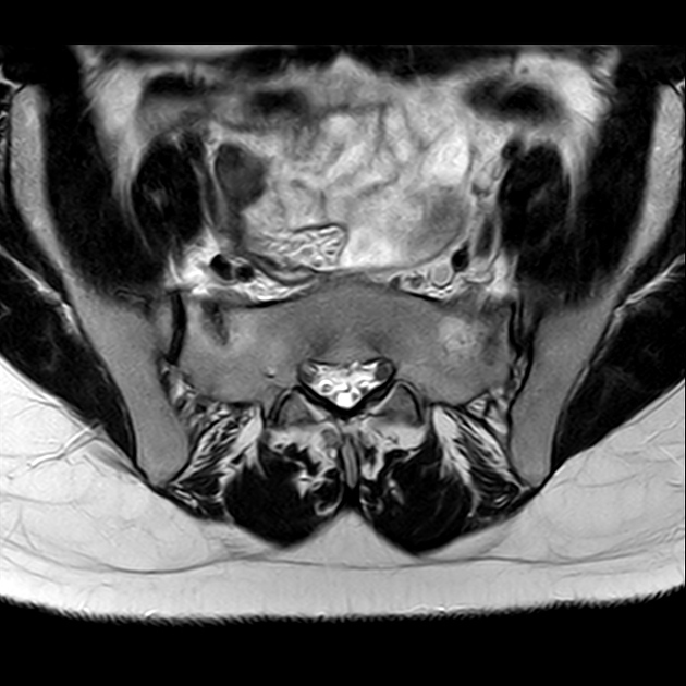 影像PPT - 【病例】骶骨功能不全骨折1例X线MR-19 影像PPT - 【病例】骶骨功能不全骨折1例X线MR-19