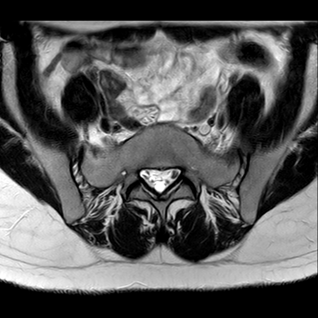 影像PPT - 【病例】骶骨功能不全骨折1例X线MR-20 影像PPT - 【病例】骶骨功能不全骨折1例X线MR-20