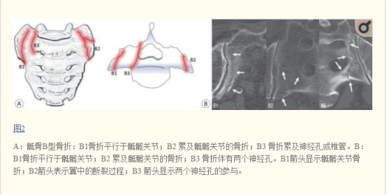 影像PPT - 【病例】骶骨功能不全骨折1例X线MR-29 影像PPT - 【病例】骶骨功能不全骨折1例X线MR-29