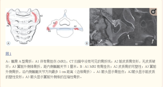 影像PPT - 【病例】骶骨功能不全骨折1例X线MR-28 影像PPT - 【病例】骶骨功能不全骨折1例X线MR-28