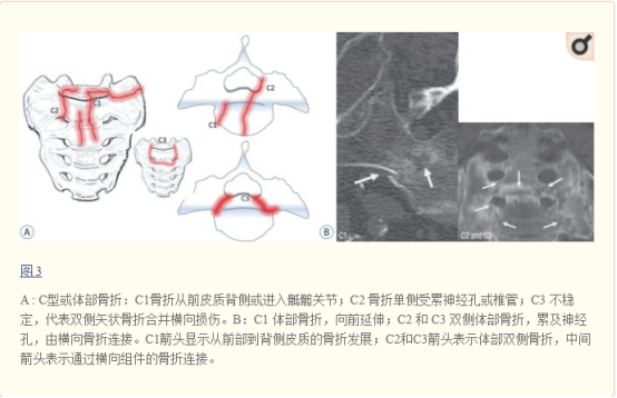 影像PPT - 【病例】骶骨功能不全骨折1例X线MR-30 影像PPT - 【病例】骶骨功能不全骨折1例X线MR-30