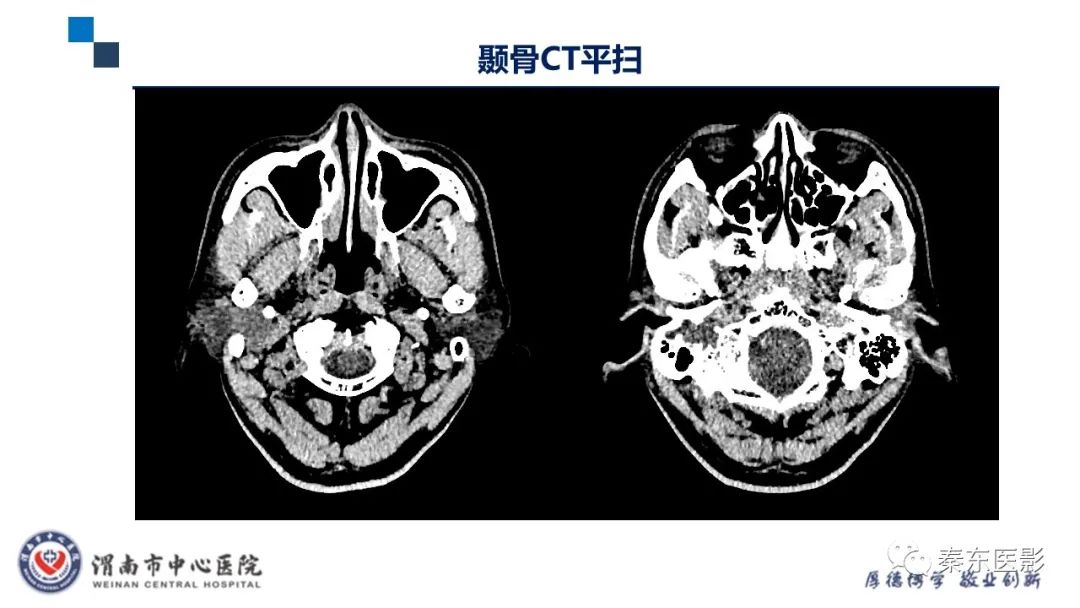 影像PPT - 【病例】面神经鞘瘤1例CT及MR影像-3