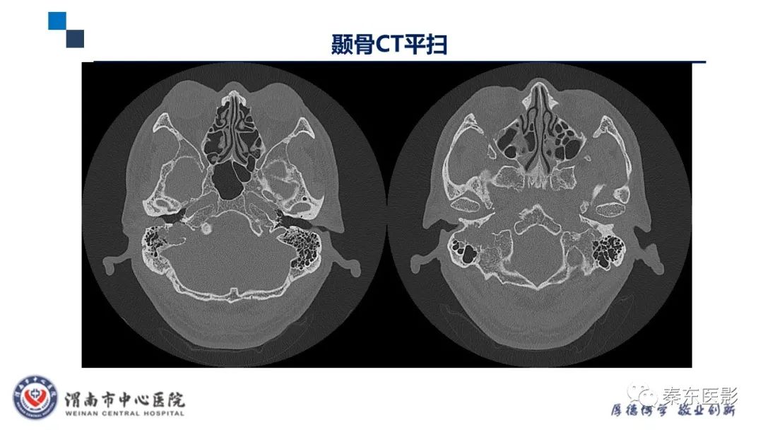 影像PPT - 【病例】面神经鞘瘤1例CT及MR影像-4