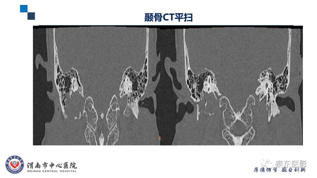 影像PPT - 【病例】面神经鞘瘤1例CT及MR影像-5