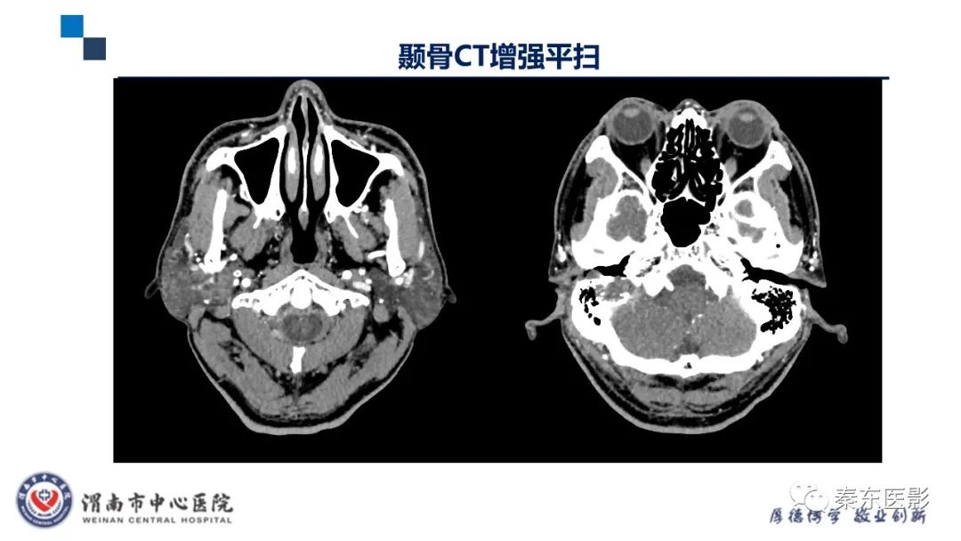 影像PPT - 【病例】面神经鞘瘤1例CT及MR影像-6