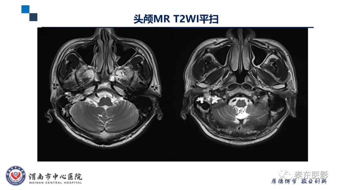 影像PPT - 【病例】面神经鞘瘤1例CT及MR影像-7