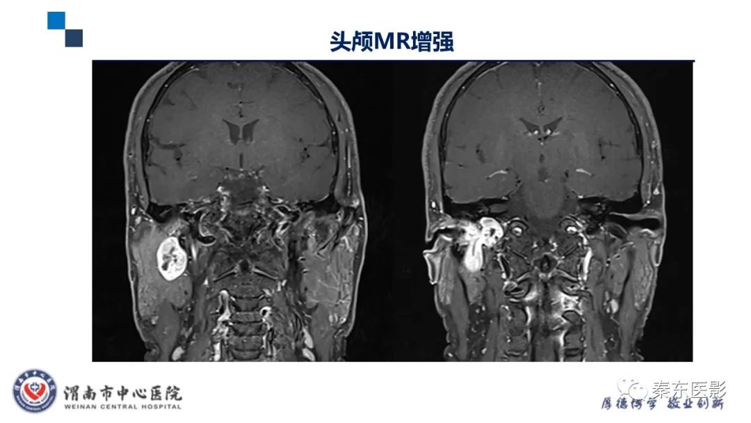 影像PPT - 【病例】面神经鞘瘤1例CT及MR影像-8