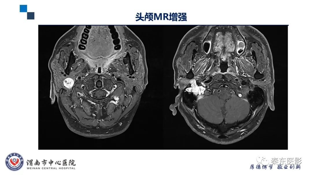 影像PPT - 【病例】面神经鞘瘤1例CT及MR影像-9