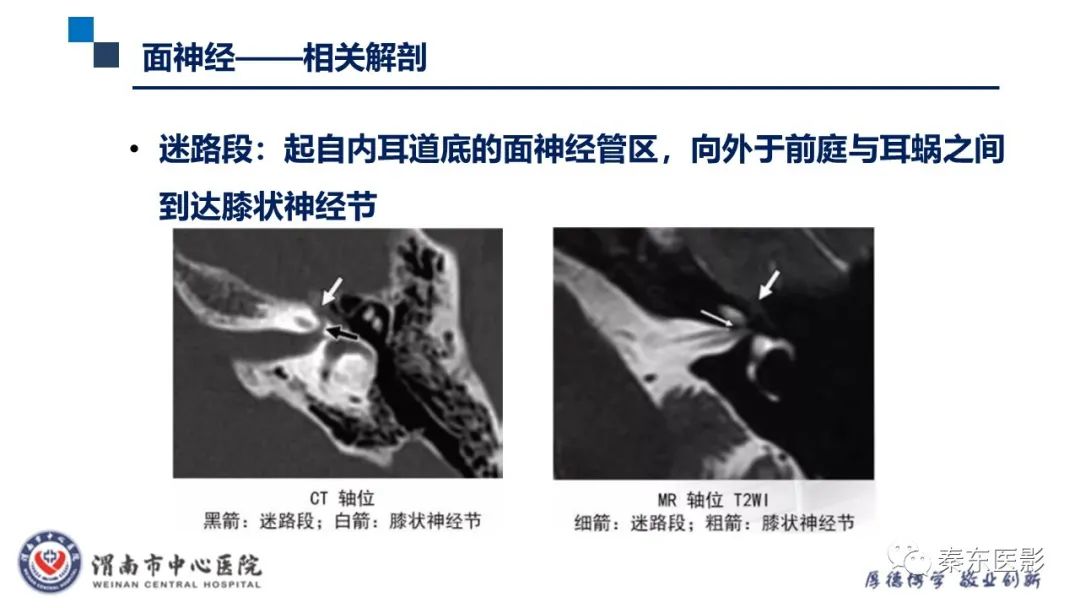 影像PPT - 【病例】面神经鞘瘤1例CT及MR影像-15