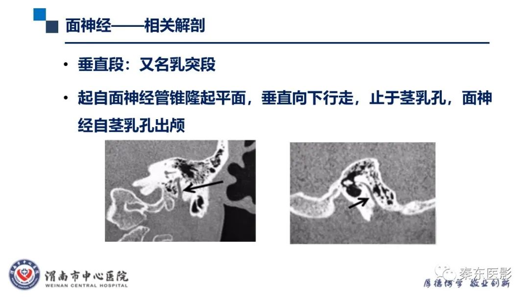 影像PPT - 【病例】面神经鞘瘤1例CT及MR影像-17