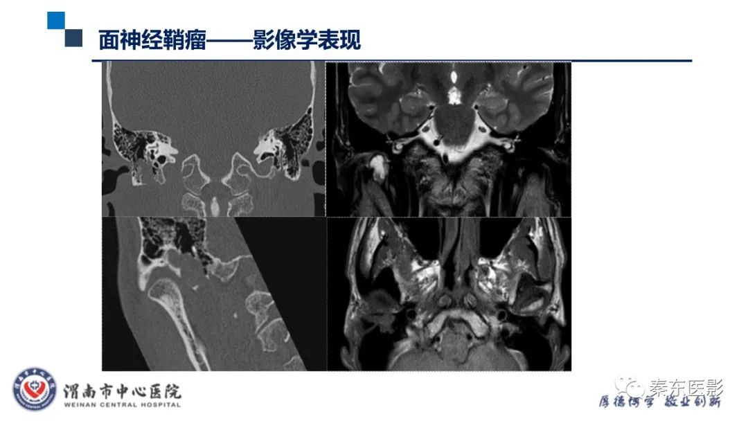 影像PPT - 【病例】面神经鞘瘤1例CT及MR影像-22