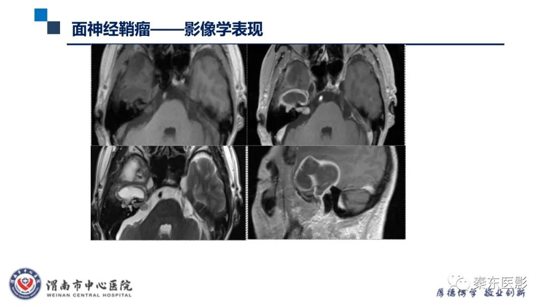 影像PPT - 【病例】面神经鞘瘤1例CT及MR影像-24