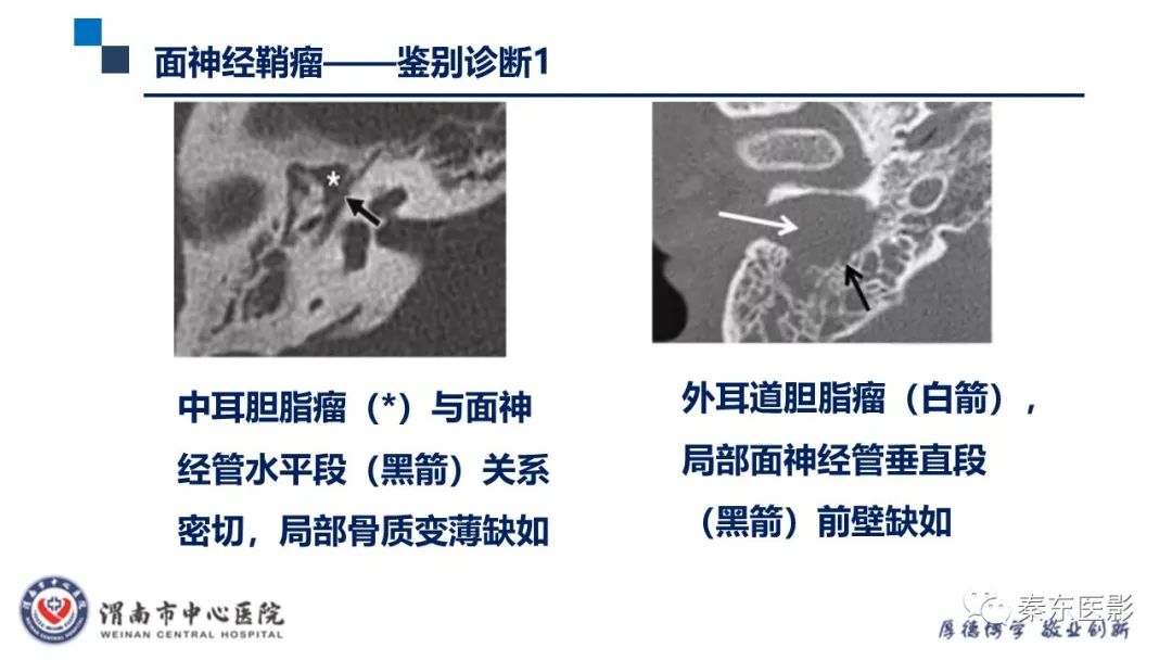影像PPT - 【病例】面神经鞘瘤1例CT及MR影像-26