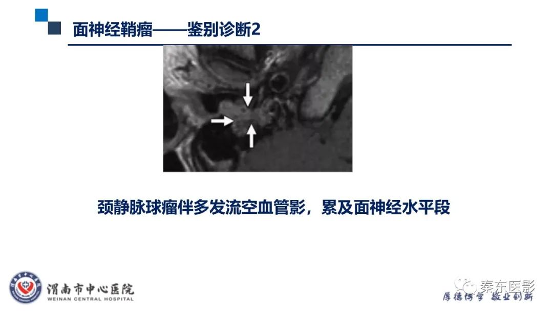 影像PPT - 【病例】面神经鞘瘤1例CT及MR影像-28