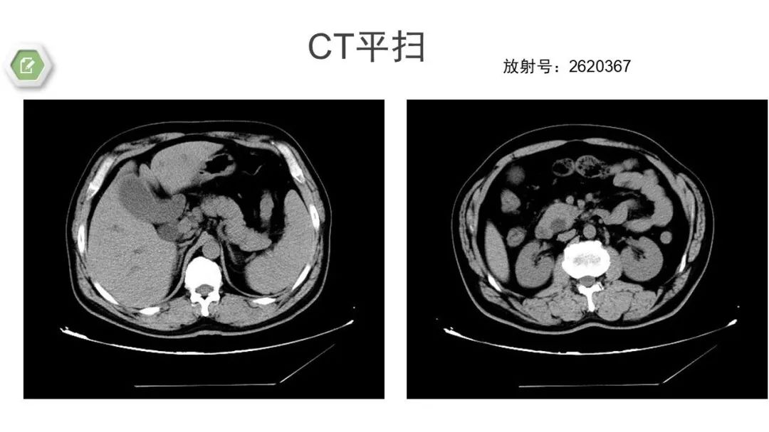 影像PPT - 【病例】壶腹周围癌1例CT影像-5 影像PPT - 【病例】壶腹周围癌1例CT影像-5