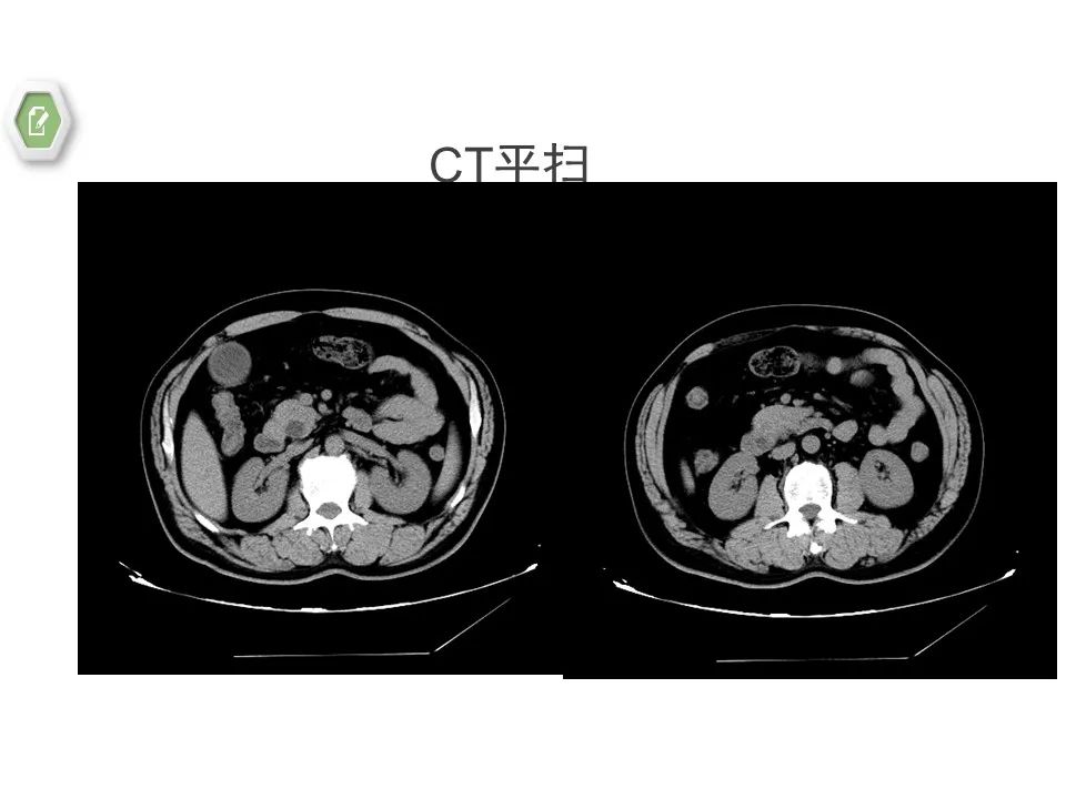 影像PPT - 【病例】壶腹周围癌1例CT影像-6 影像PPT - 【病例】壶腹周围癌1例CT影像-6
