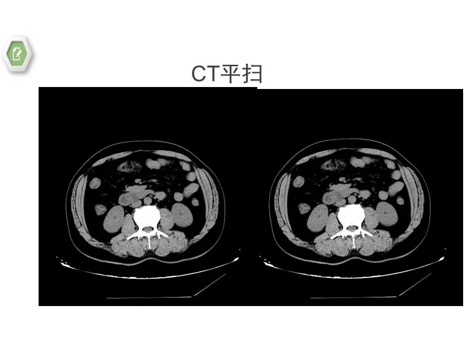 影像PPT - 【病例】壶腹周围癌1例CT影像-7 影像PPT - 【病例】壶腹周围癌1例CT影像-7