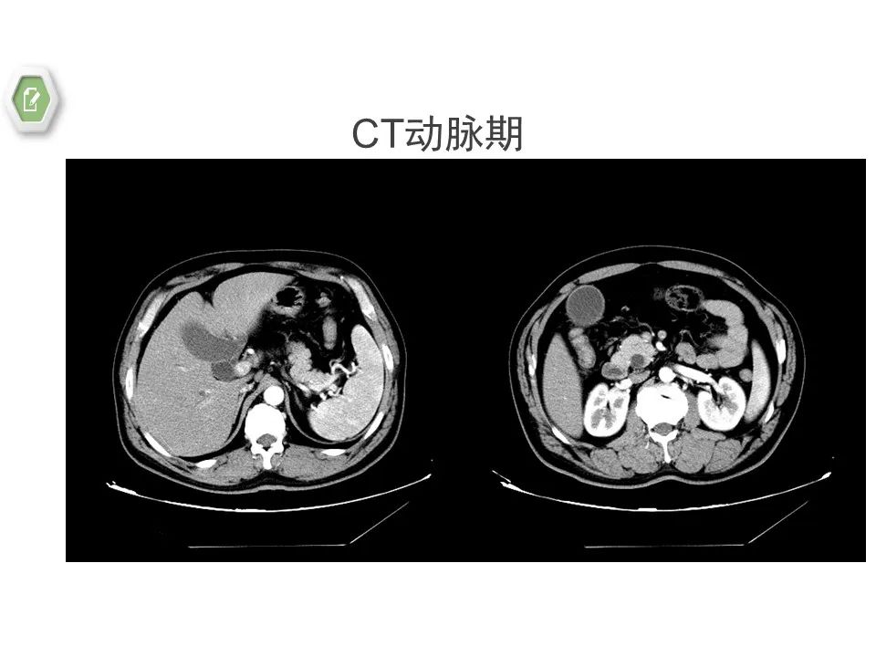 影像PPT - 【病例】壶腹周围癌1例CT影像-8 影像PPT - 【病例】壶腹周围癌1例CT影像-8