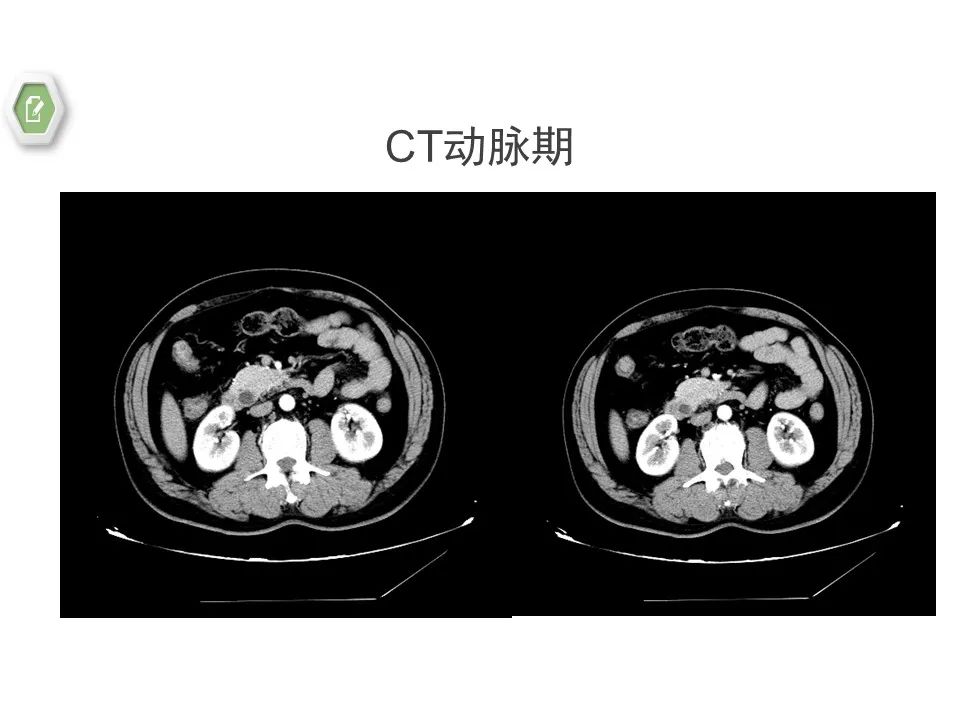 影像PPT - 【病例】壶腹周围癌1例CT影像-9 影像PPT - 【病例】壶腹周围癌1例CT影像-9