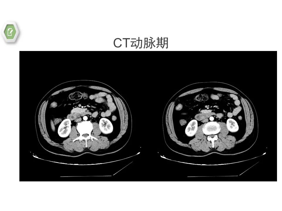 影像PPT - 【病例】壶腹周围癌1例CT影像-10 影像PPT - 【病例】壶腹周围癌1例CT影像-10