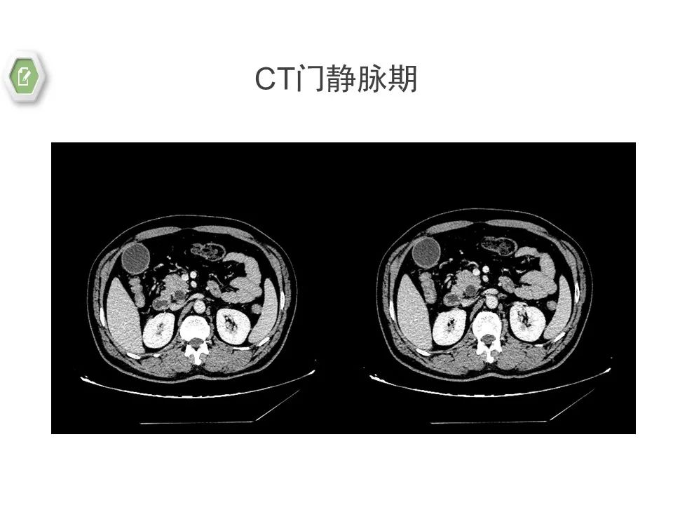 影像PPT - 【病例】壶腹周围癌1例CT影像-11 影像PPT - 【病例】壶腹周围癌1例CT影像-11