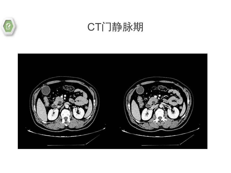 影像PPT - 【病例】壶腹周围癌1例CT影像-12 影像PPT - 【病例】壶腹周围癌1例CT影像-12