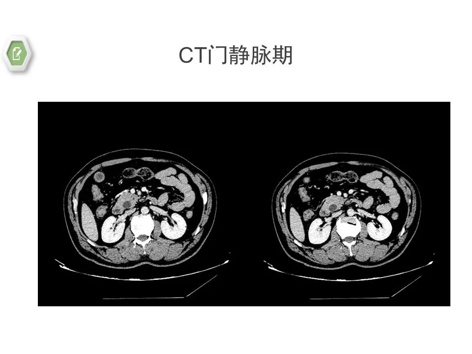 影像PPT - 【病例】壶腹周围癌1例CT影像-13 影像PPT - 【病例】壶腹周围癌1例CT影像-13