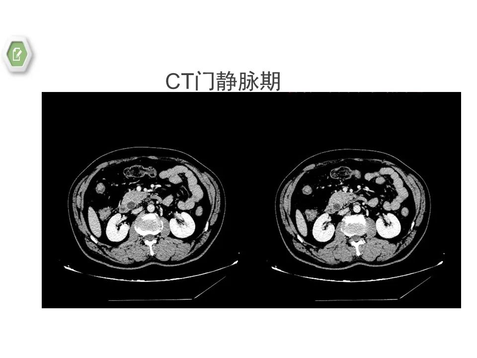 影像PPT - 【病例】壶腹周围癌1例CT影像-14 影像PPT - 【病例】壶腹周围癌1例CT影像-14