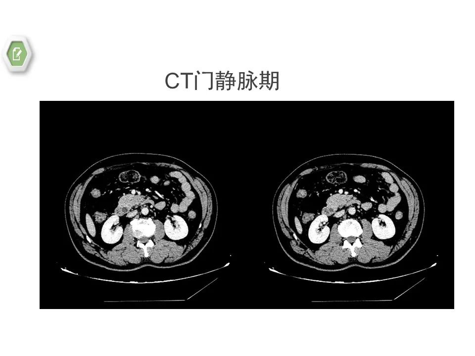 影像PPT - 【病例】壶腹周围癌1例CT影像-15 影像PPT - 【病例】壶腹周围癌1例CT影像-15