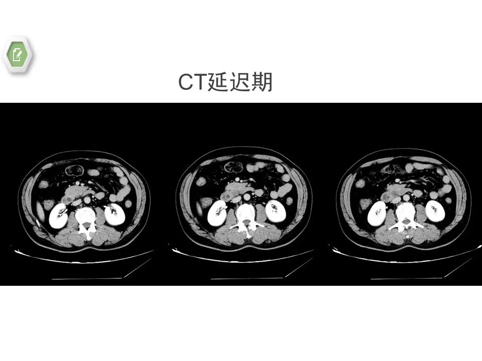 影像PPT - 【病例】壶腹周围癌1例CT影像-16 影像PPT - 【病例】壶腹周围癌1例CT影像-16