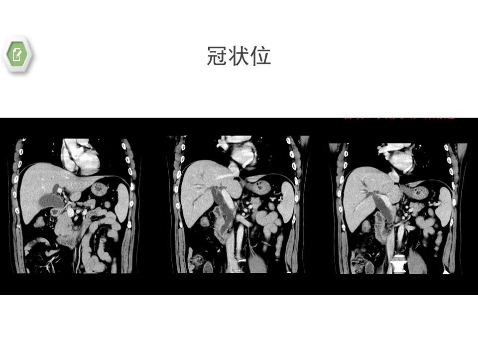 影像PPT - 【病例】壶腹周围癌1例CT影像-17 影像PPT - 【病例】壶腹周围癌1例CT影像-17