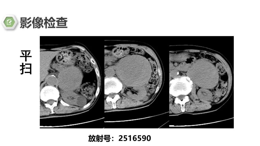 影像PPT - 【病例】肾上腺嗜铬细胞瘤1例CT影像-4 影像PPT - 【病例】肾上腺嗜铬细胞瘤1例CT影像-4