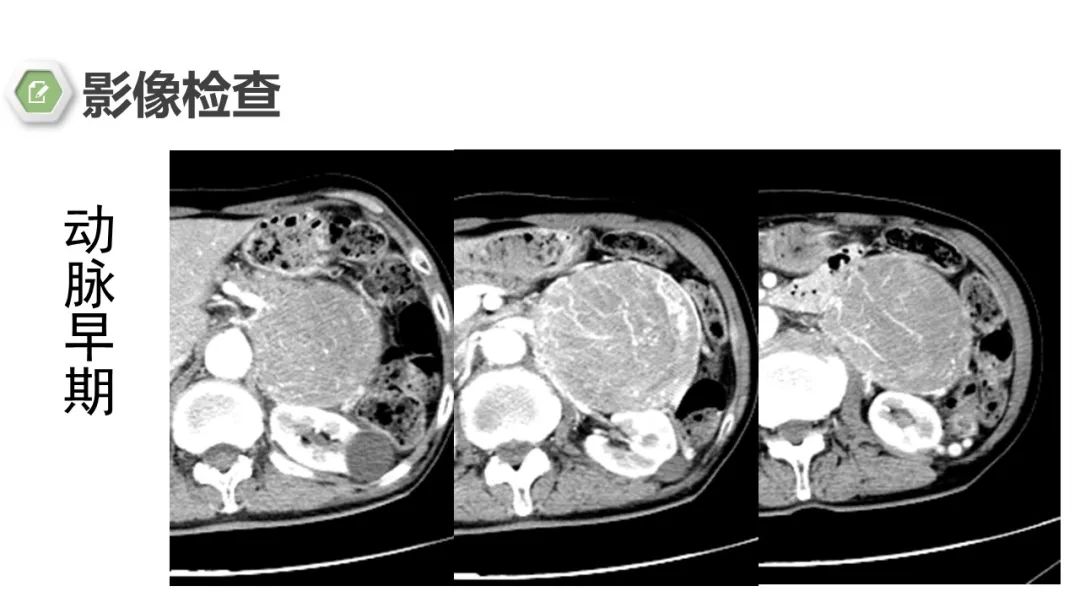 影像PPT - 【病例】肾上腺嗜铬细胞瘤1例CT影像-5 影像PPT - 【病例】肾上腺嗜铬细胞瘤1例CT影像-5