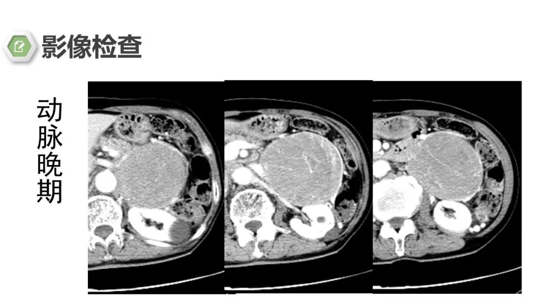 影像PPT - 【病例】肾上腺嗜铬细胞瘤1例CT影像-6 影像PPT - 【病例】肾上腺嗜铬细胞瘤1例CT影像-6
