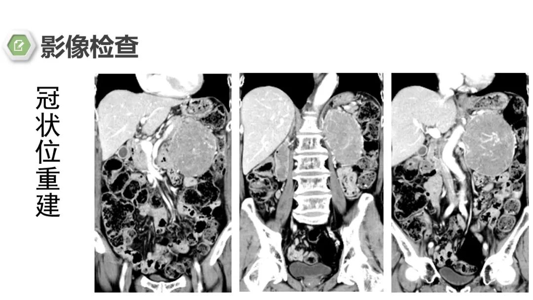 影像PPT - 【病例】肾上腺嗜铬细胞瘤1例CT影像-8 影像PPT - 【病例】肾上腺嗜铬细胞瘤1例CT影像-8
